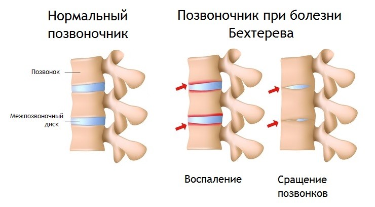Изменения в позвоночнике при анкилозирующем спондилоартрите
