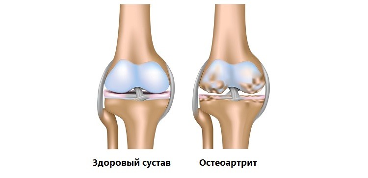 Что такое остеоартрит?