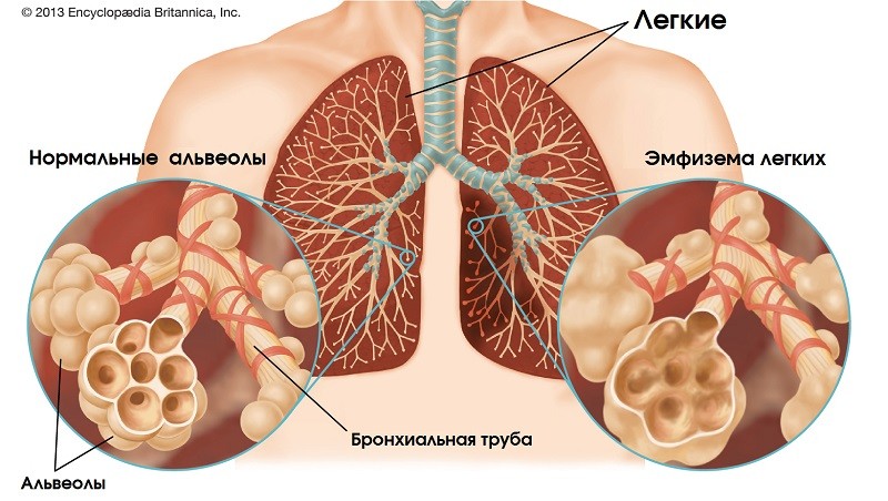 Эмфизема легких