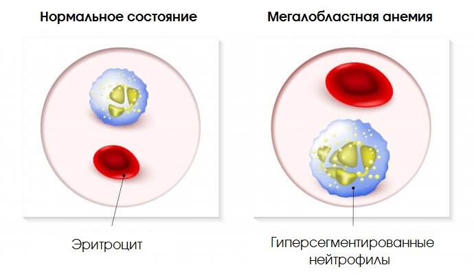 Мегалобластная анемия