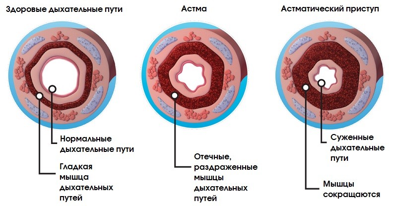 Что такое бронхиальная астма
