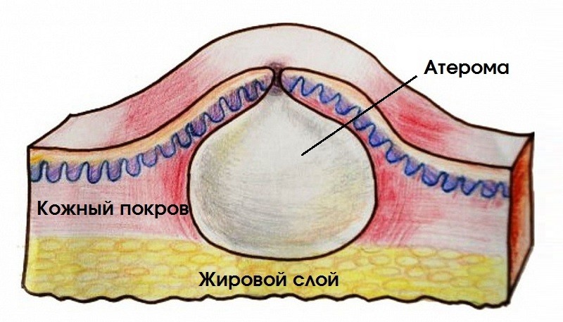 Атерома