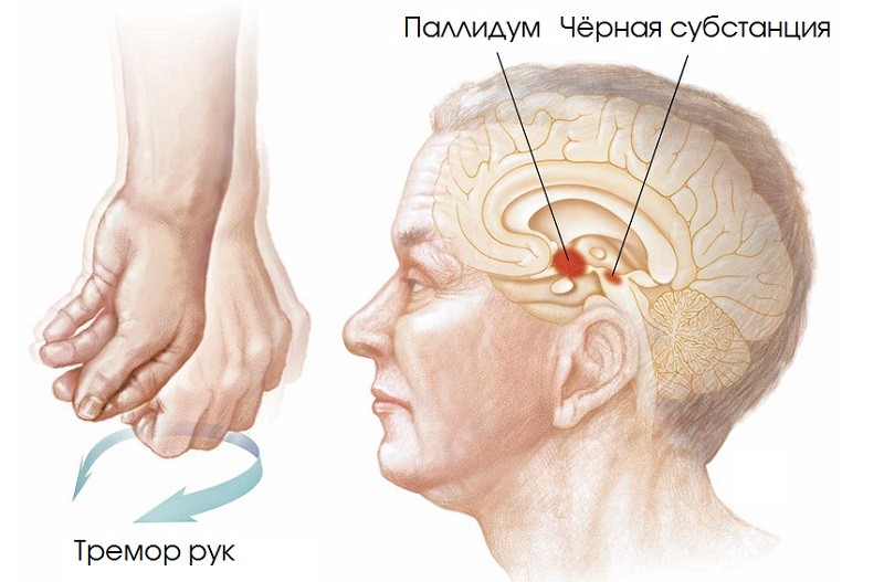 Симптомы болезни Паркинсона