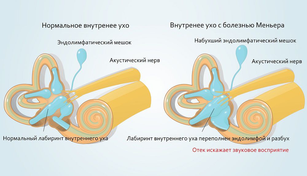 Что такое болезнь Меньера