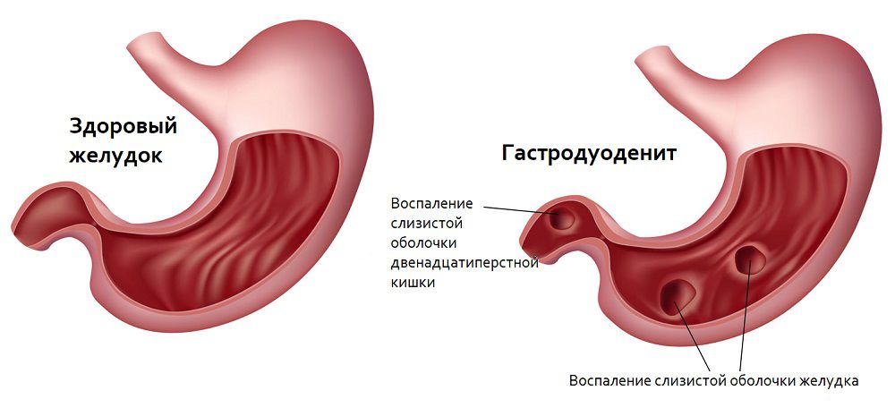 Что такое гастродуоденит