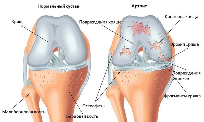 Артроз коленного сустава