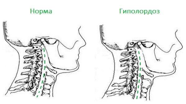 Гиполордоз