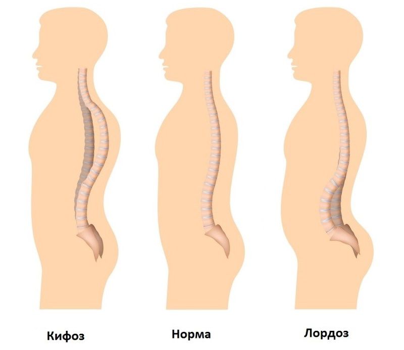 Лордоз и кифоз