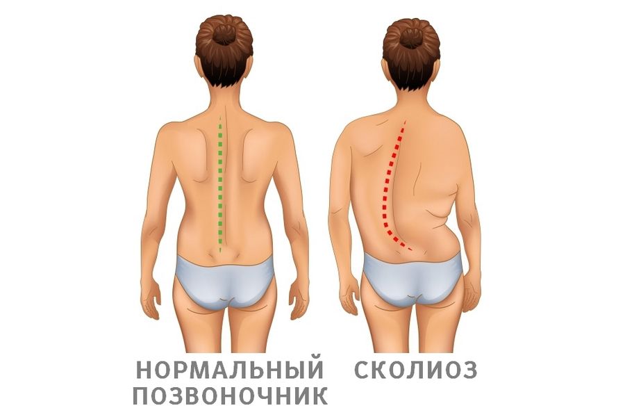 Сколиоз
