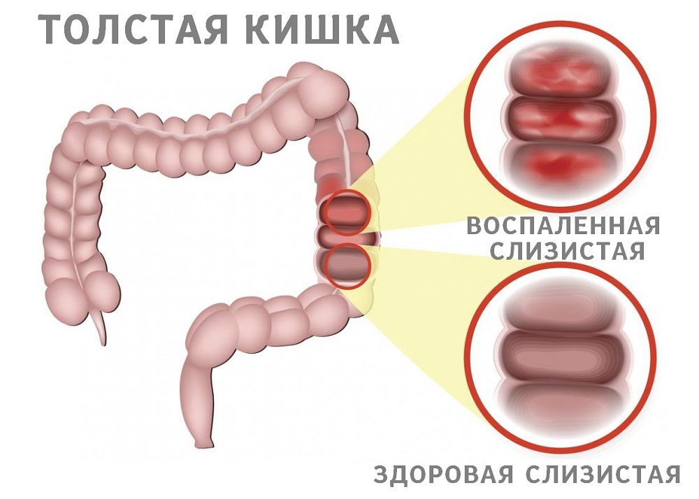 Колит