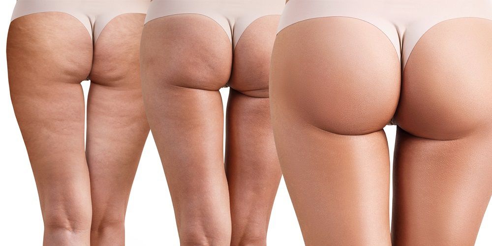 Как избавиться от целлюлита
