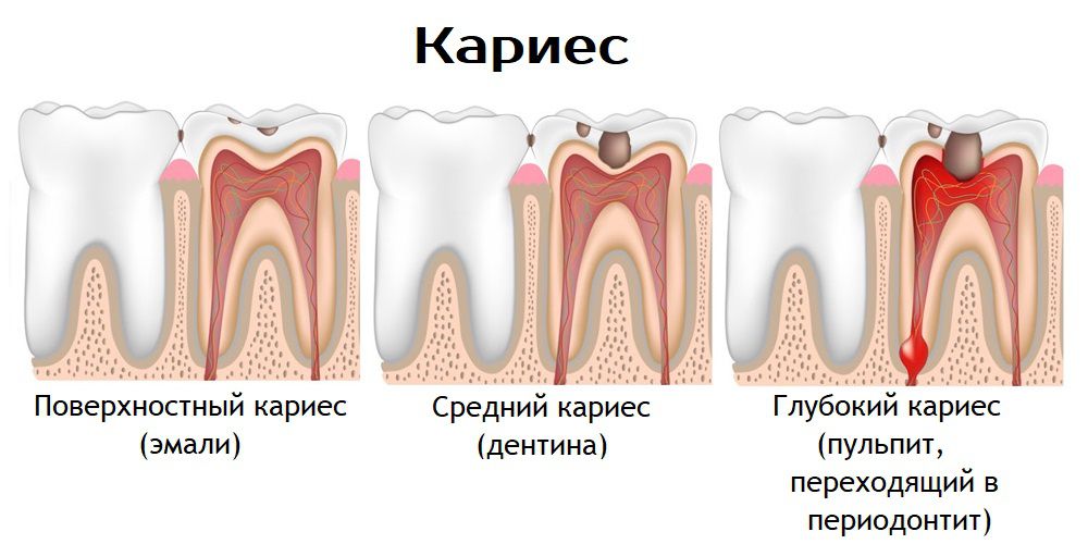 Кариес
