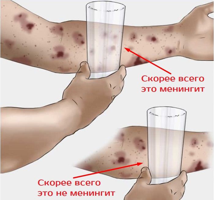 Тест на менингит "Стакан и сыпь"