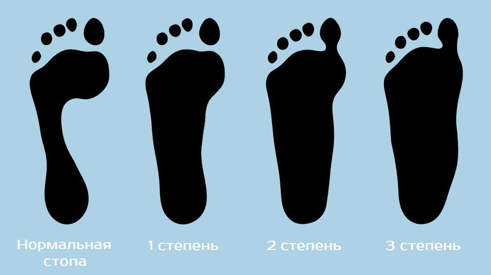 Степени плоскостопия