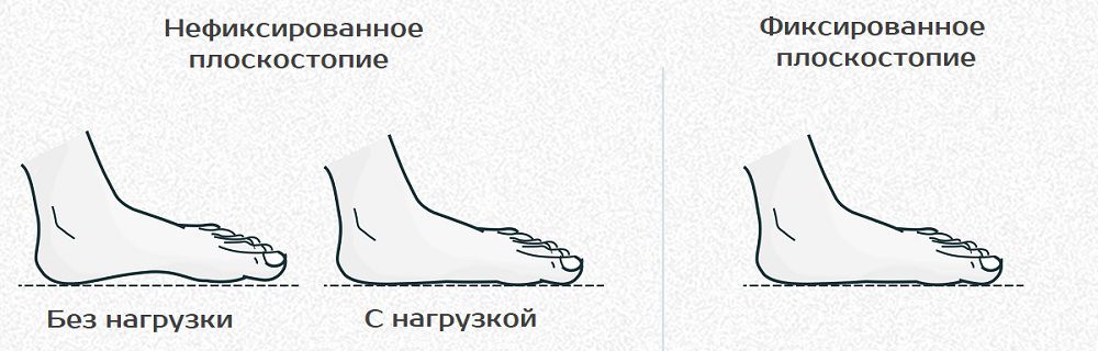 Фиксированное и нефиксированное плоскостопие