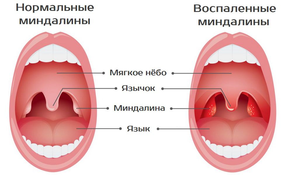 Фарингит