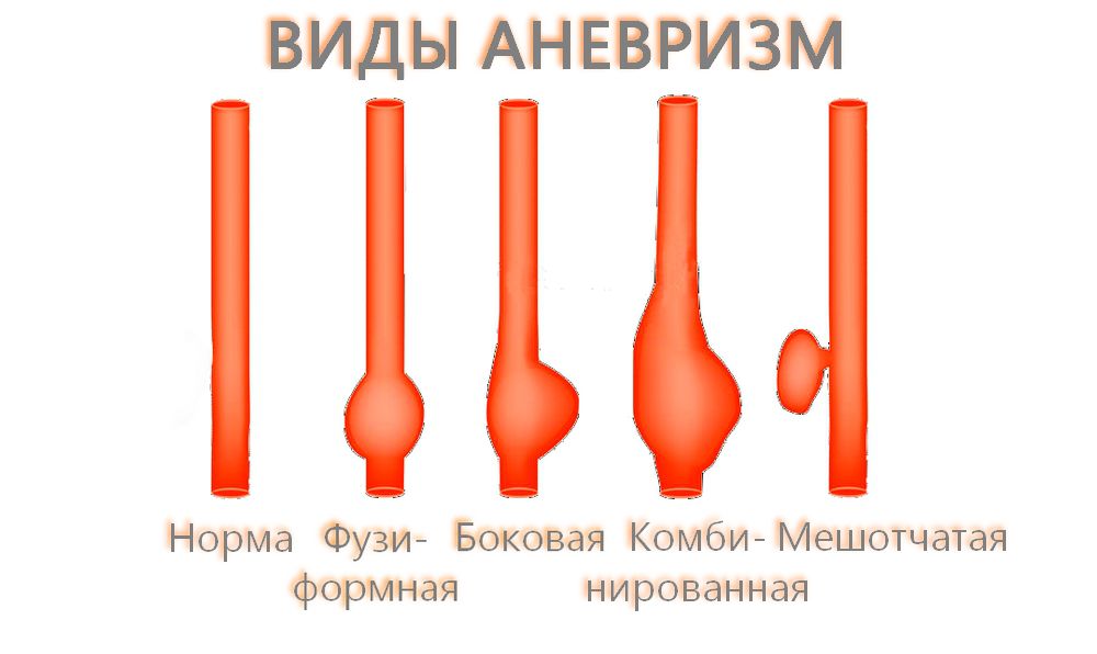 Виды аневризм
