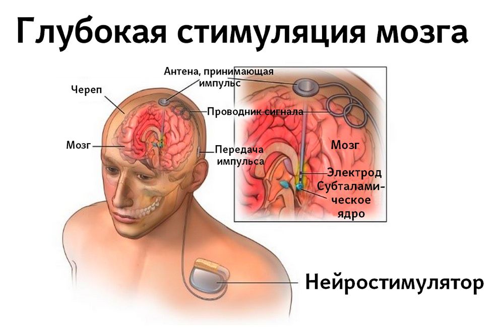 Глубокая стимуляция мозга