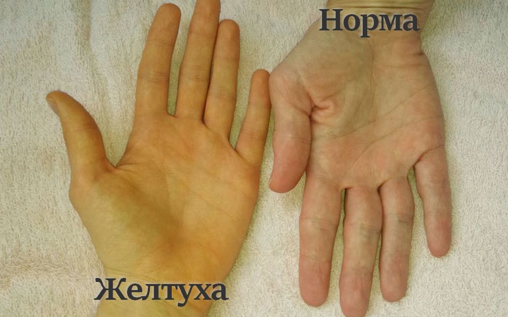 Желтуха