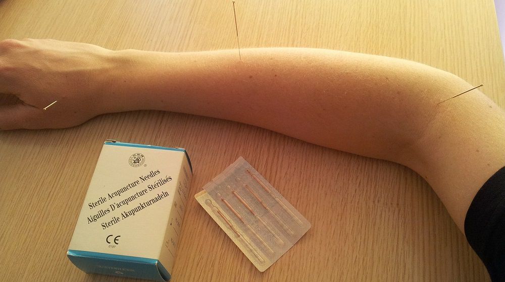 Акупунктура